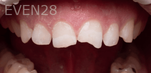 Vu-Le-Dental-Bonding-before-1