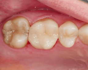 Vu-Le-Dental-Crown-before-1