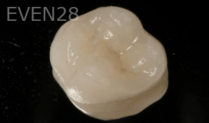 Vu-Le-Dental-Crown-before-1b