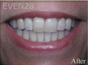 William-Poe-Porcelain-Veneers-after-1