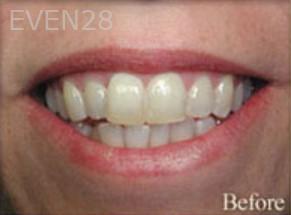 William-Poe-Porcelain-Veneers-before-1