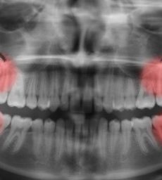 Wisdom-teeth-Four-Sedation