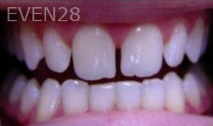 Aaron-Choroomi-Dental-Bonding-before-1b
