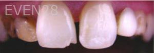 Aaron-Choroomi-Dental-Bridge-before-1b