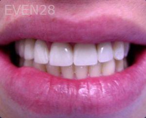 Aaron-Choroomi-Dental-Implants-after-1b