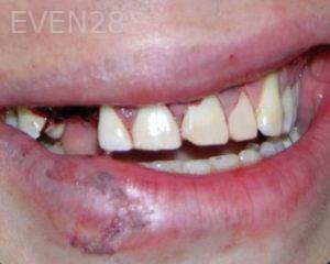 Aaron-Choroomi-Dental-Implants-before-1b