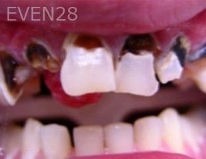 Aaron-Choroomi-Full-Mouth-Rehabilitation-before-1b
