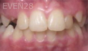 Aaron-Choroomi-Orthodontic-Braces-before-1b
