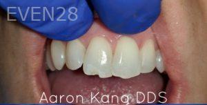 Aaron-Kang-Dental-Bonding-before-1
