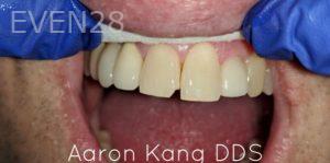 Aaron-Kang-Dental-Bonding-before-2