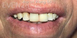 Aaron-Kang-Dental-Crowns-after-1