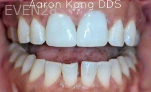 Aaron-Kang-Dental-Crowns-after-2