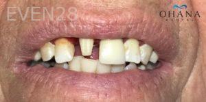 Aaron-Kang-Dental-Crowns-before-1