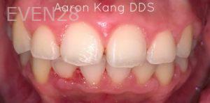 Aaron-Kang-Orthodontic-Braces-after-2b