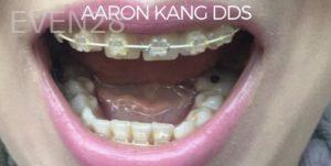 Aaron-Kang-Orthodontic-Braces-after-4