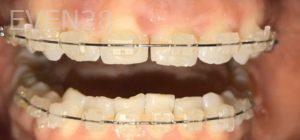 Aaron-Kang-Orthodontic-Braces-before-1