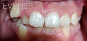 Aaron-Kang-Orthodontic-Braces-before-2