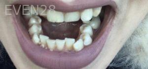 Aaron-Kang-Orthodontic-Braces-before-4
