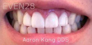 Aaron-Kang-Smile-Makeover-after-1