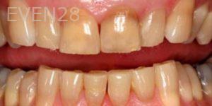 Aaron-Kang-Teeth-Whitening-before-1