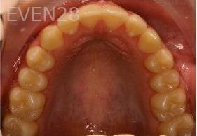 Abbas-Eftekhari-Orthodontic-Braces-after-1c