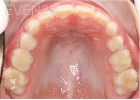 Abbas-Eftekhari-Orthodontic-Braces-after-2c