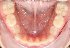 Abbas-Eftekhari-Orthodontic-Braces-after-2d