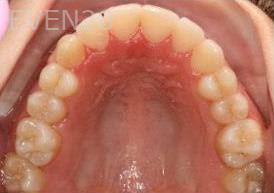 Abbas-Eftekhari-Orthodontic-Braces-after-3c