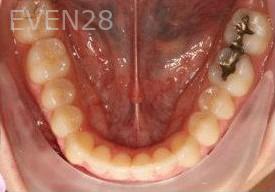 Abbas-Eftekhari-Orthodontic-Braces-after-3d