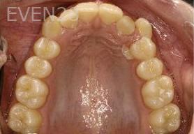 Abbas-Eftekhari-Orthodontic-Braces-before-1c