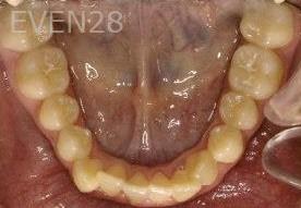 Abbas-Eftekhari-Orthodontic-Braces-before-1d