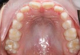 Abbas-Eftekhari-Orthodontic-Braces-before-2c
