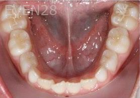 Abbas-Eftekhari-Orthodontic-Braces-before-2d