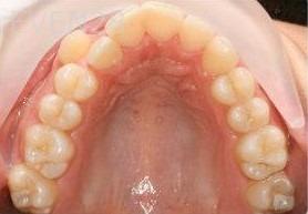 Abbas-Eftekhari-Orthodontic-Braces-before-3c