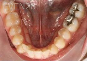 Abbas-Eftekhari-Orthodontic-Braces-before-3d
