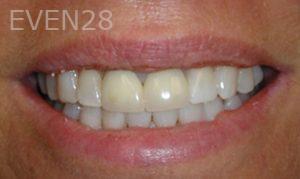 Akash-Lapsi-Dental-Crowns-before-1