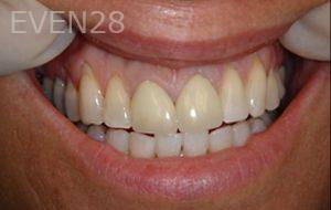 Akash-Lapsi-Dental-Crowns-before-1b