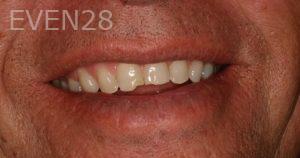 Ana-Niehoff-Dental-Bonding-before-1