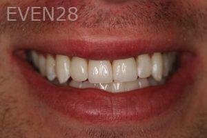 Ana-Niehoff-Dental-Crowns-after-1