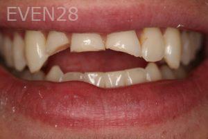 Ana-Niehoff-Dental-Crowns-before-1