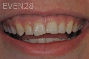 Andrew-Goldenberg-Dental-Bonding-before-1