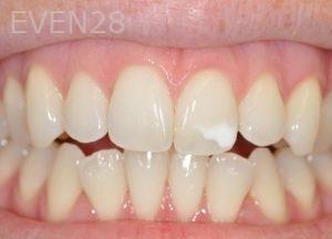 Andrew-Goldenberg-Dental-Bonding-before-2
