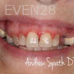 Andrew-Spath-Full-Mouth-Rehabilitation-before-2b