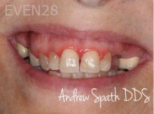 Andrew-Spath-Full-Mouth-Rehabilitation-before-2b