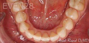 Anjali-Rajpal-Invisalign-Clear-Aligners-after-3