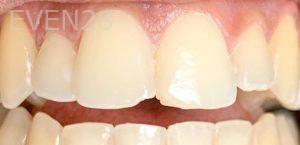 Ariga-Abrahamian-Dental-Bonding-before-1