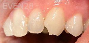 Ariga-Abrahamian-Dental-Bonding-before-2