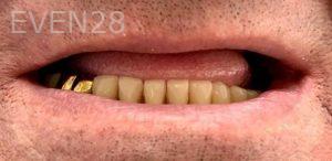 Ariga-Abrahamian-Dentures-before-1