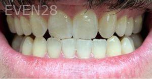 Ariga-Abrahamian-Teeth-Whitening-after-1