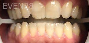 Ariga-Abrahamian-Teeth-Whitening-before-1